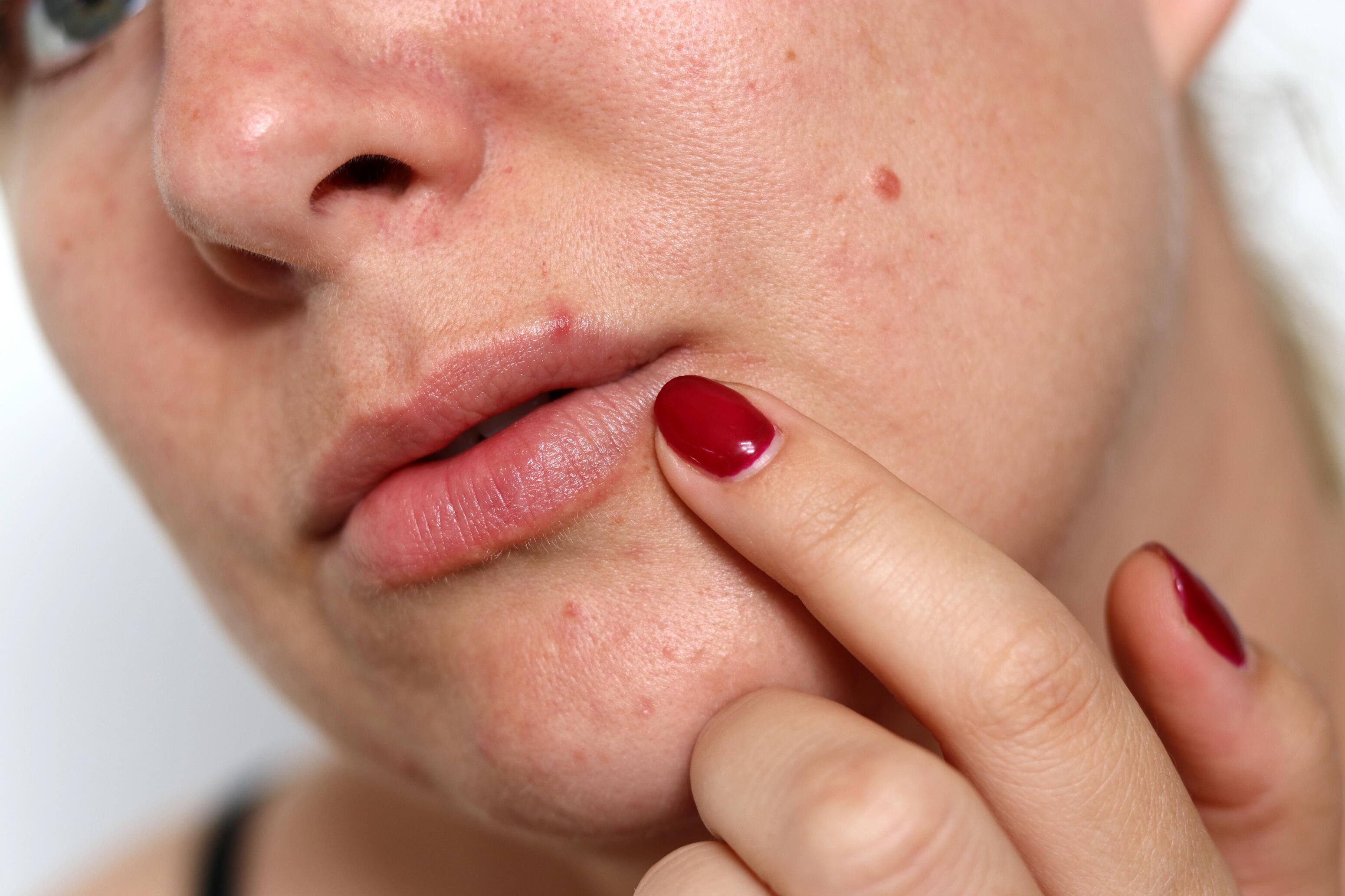 Unterschiede zwischen Akne und Fieberbläschen an den Lippen